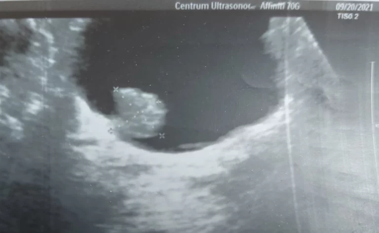 brodawczak pęcherza moczowego w obrazie USG