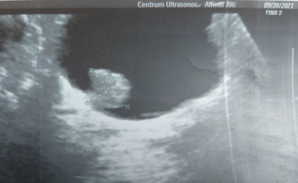 brodawczak pęcherza moczowego w obrazie USG