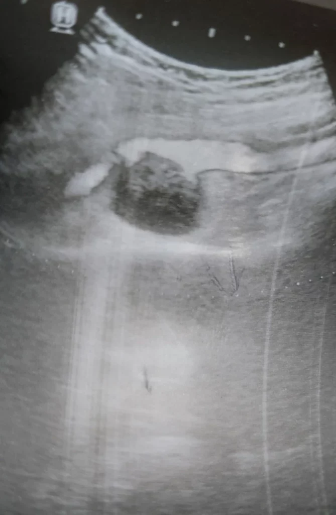 tętniak tętnicy podkolanowej w obrazie USG