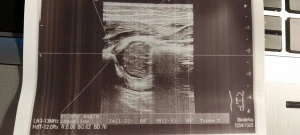 USG stawów biodrowych niemowląt Zabrze